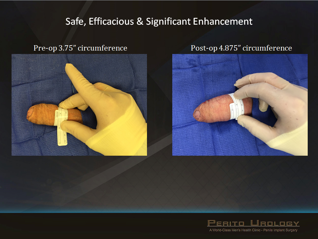 Vitamins are essential for penis enlargement